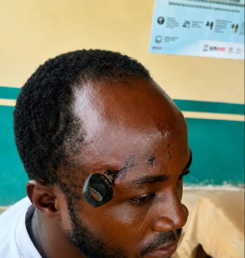 Doctors successfully remove motorbike key from farmer's skull after Jasikan attack