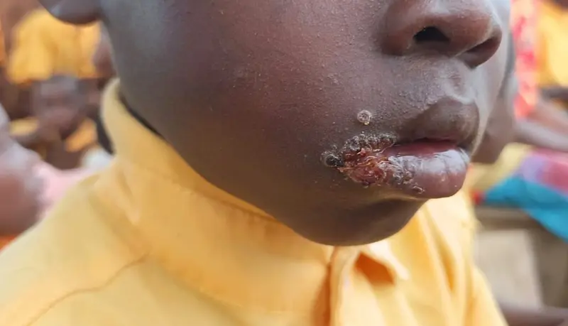 Mafi Kope residents appeal for urgent medical intervention over illnesses affecting children, adults